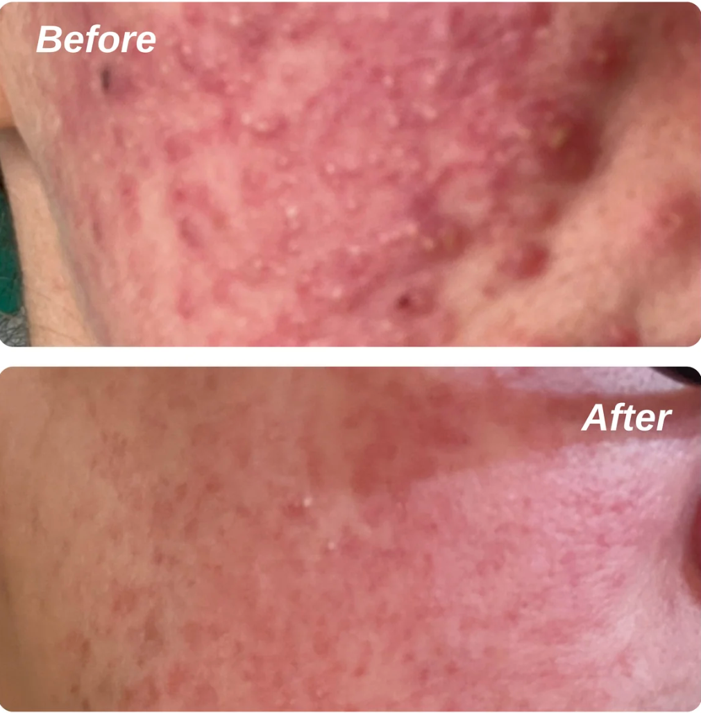 Ruddi 10% Azelaic Acid