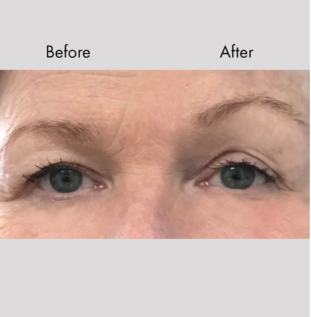 Instant Face & Brow Lift