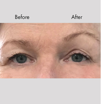 Instant Face & Brow Lift