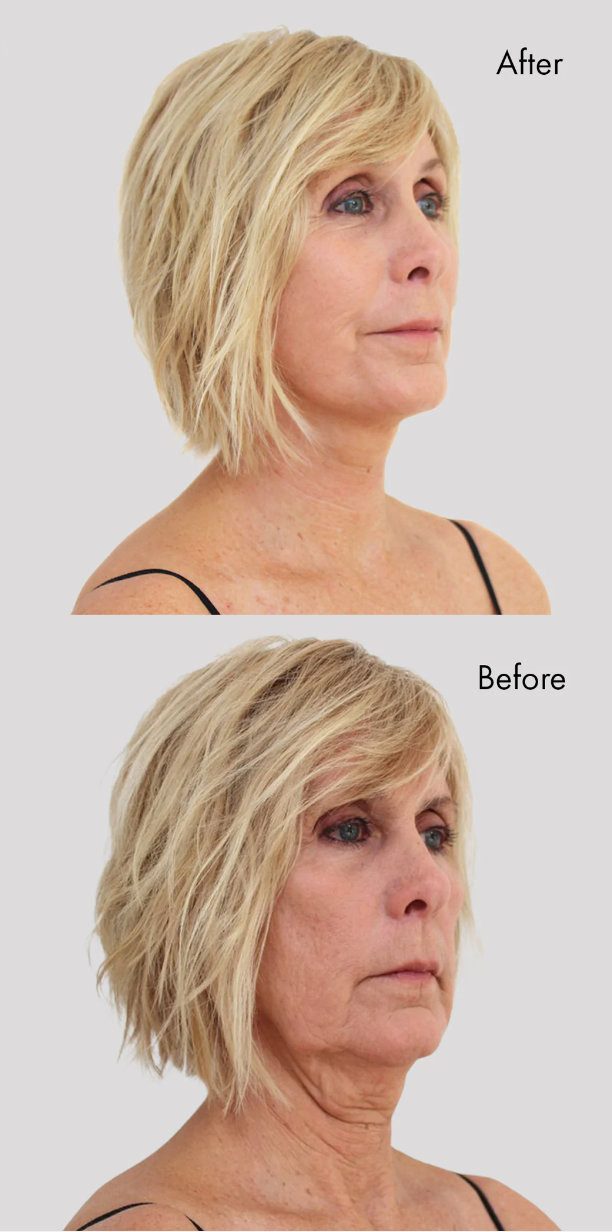 Instant Face & Brow Lift