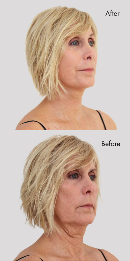 Instant Face & Brow Lift