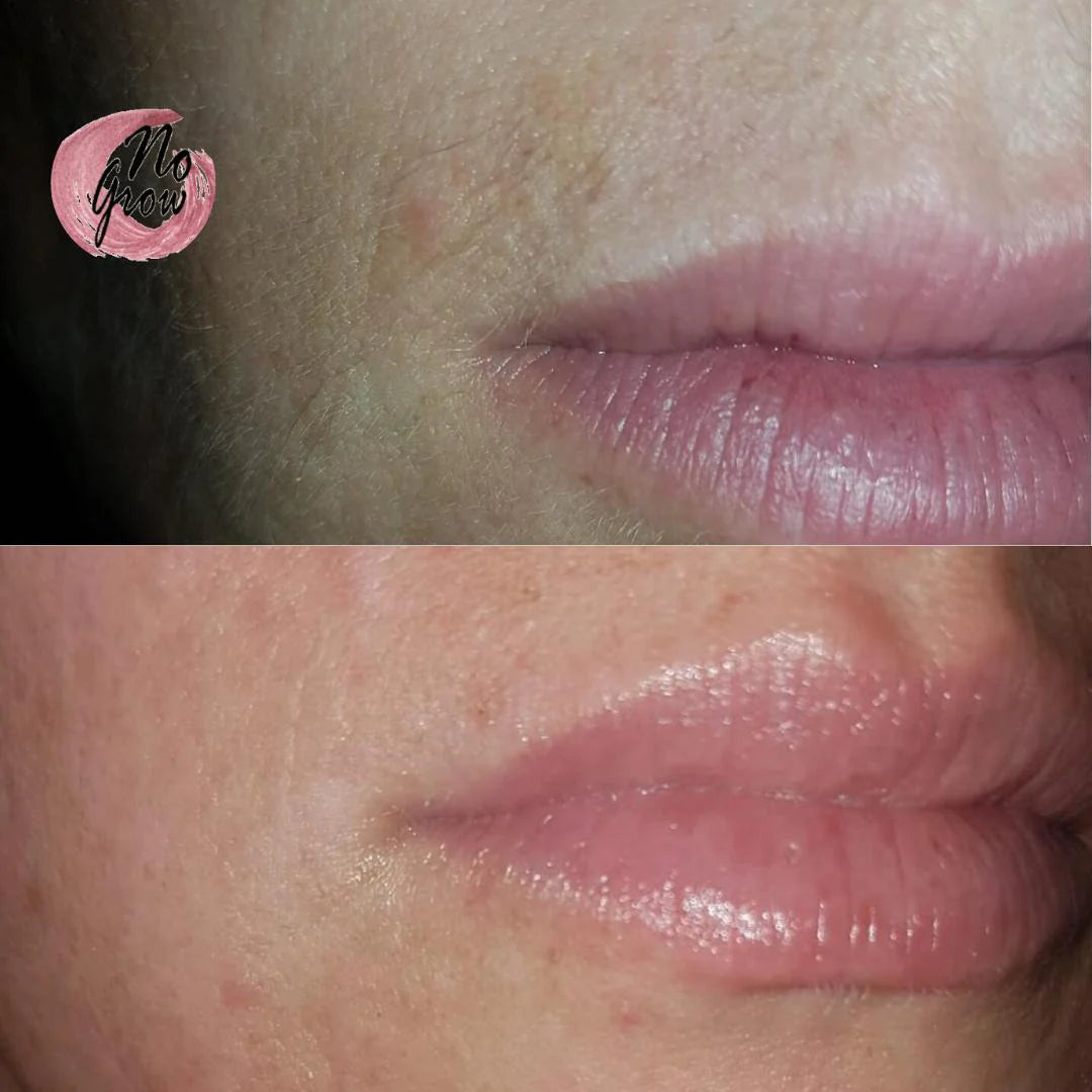 Female Facial Hair Remover & Growth Inhibitor
