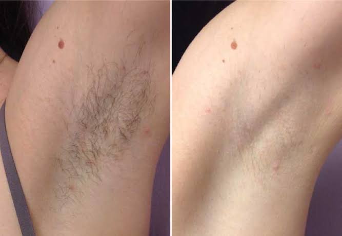 Intimate Area Hair Remover & Growth Inhibitor
