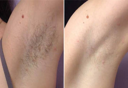 Intimate Area Hair Remover & Growth Inhibitor