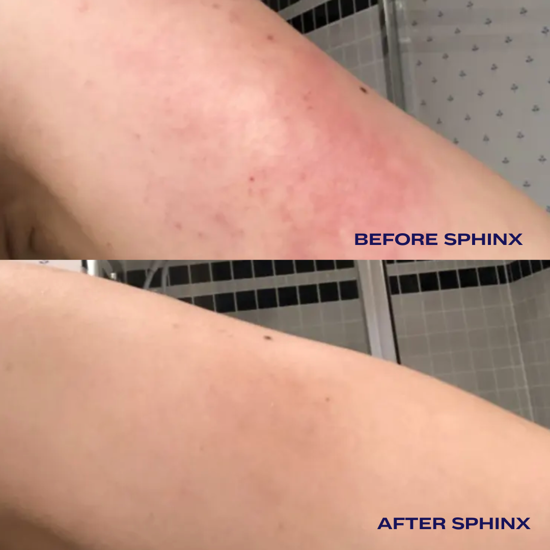 Sphinx Body Oil For Eczema And Rosacea Relief