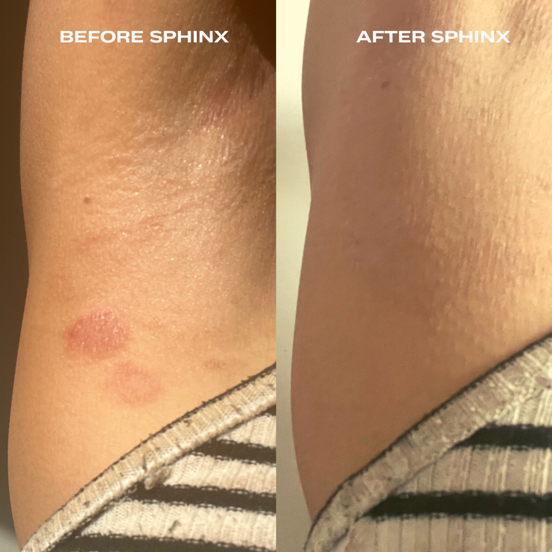 Sphinx Body Oil For Eczema And Rosacea Relief