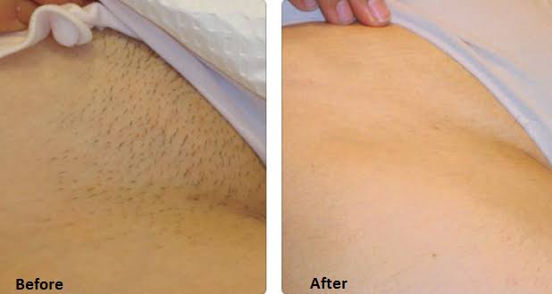 Intimate Area Hair Remover & Growth Inhibitor