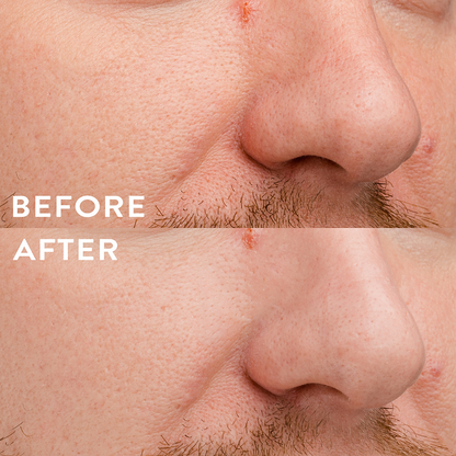 Hydro-Patch Nose
